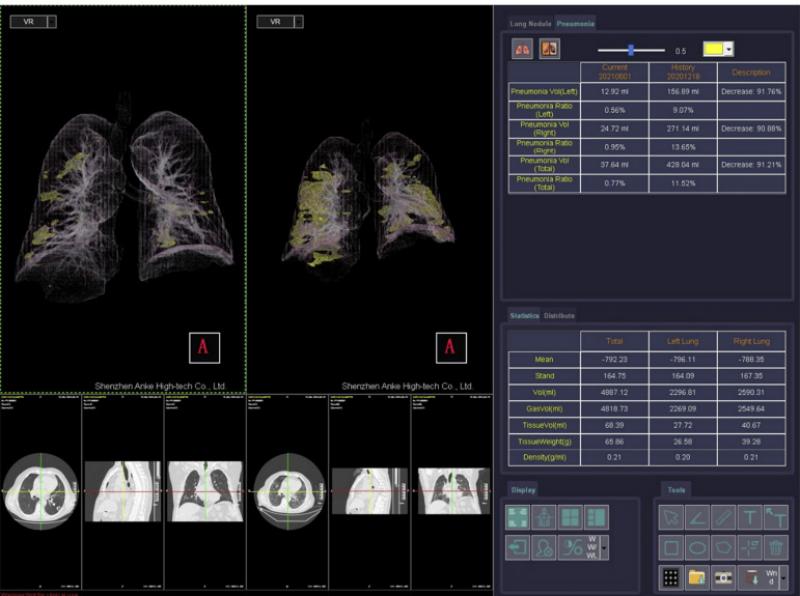 Quantitative Analysis of Residual COVID-19 Lung CT Features: Consistency among Two Commercial Software